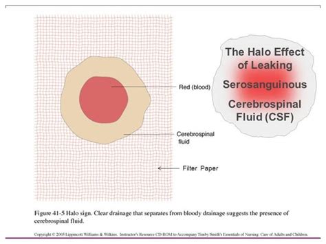 halo sign csf|Traumatic Cerebrospinal Fluid Leak: Diagnosis and Management